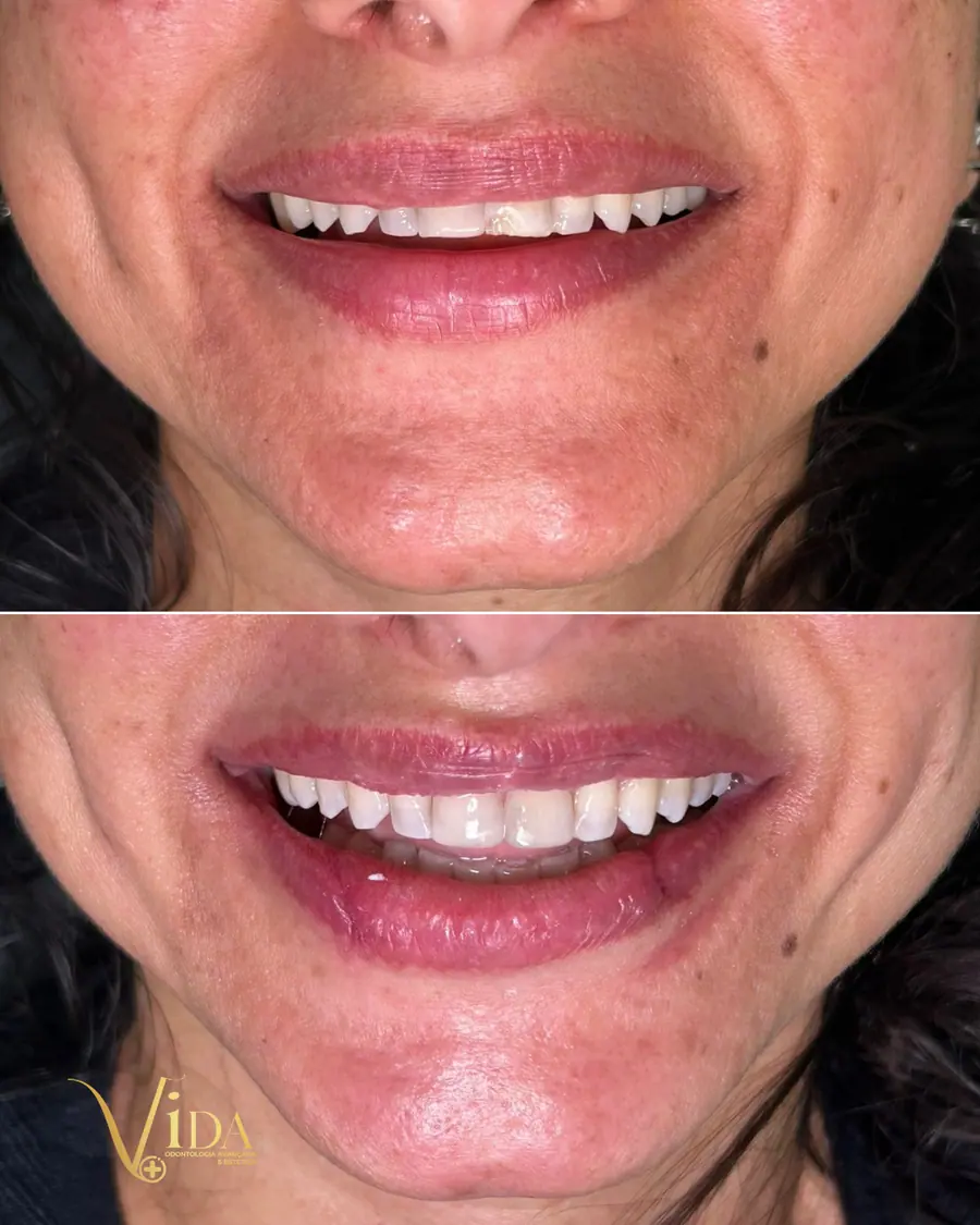 Facetas em resina - caso 34
