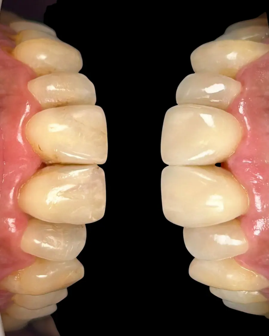 Facetas em resina - caso 35