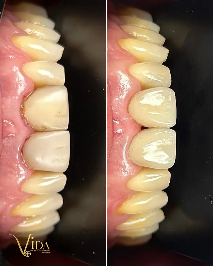 Facetas em resina - caso 36