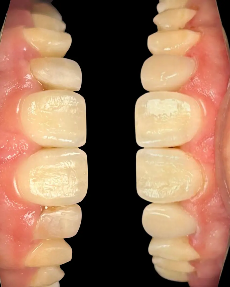 Facetas em resina - caso 37