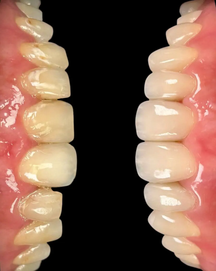 Facetas em resina - caso 38