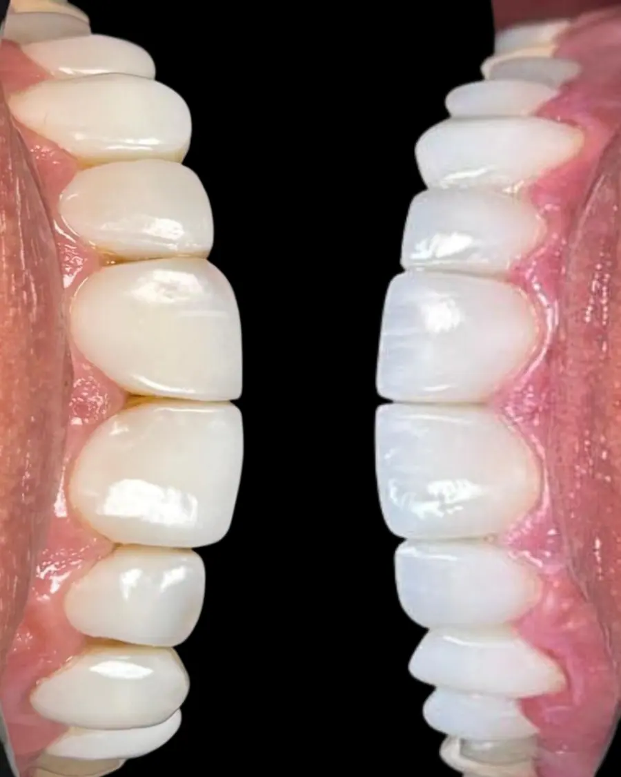 Facetas em resina - caso 39