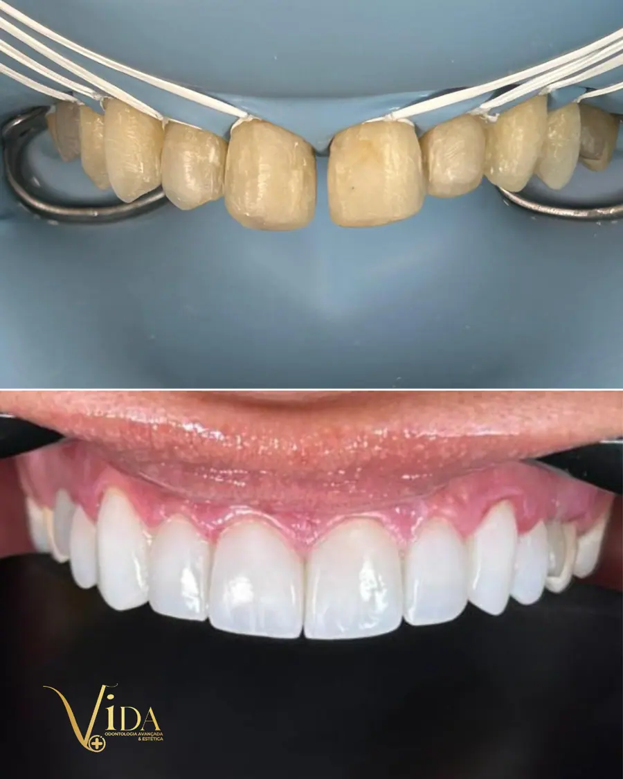 Facetas em resina - caso 40