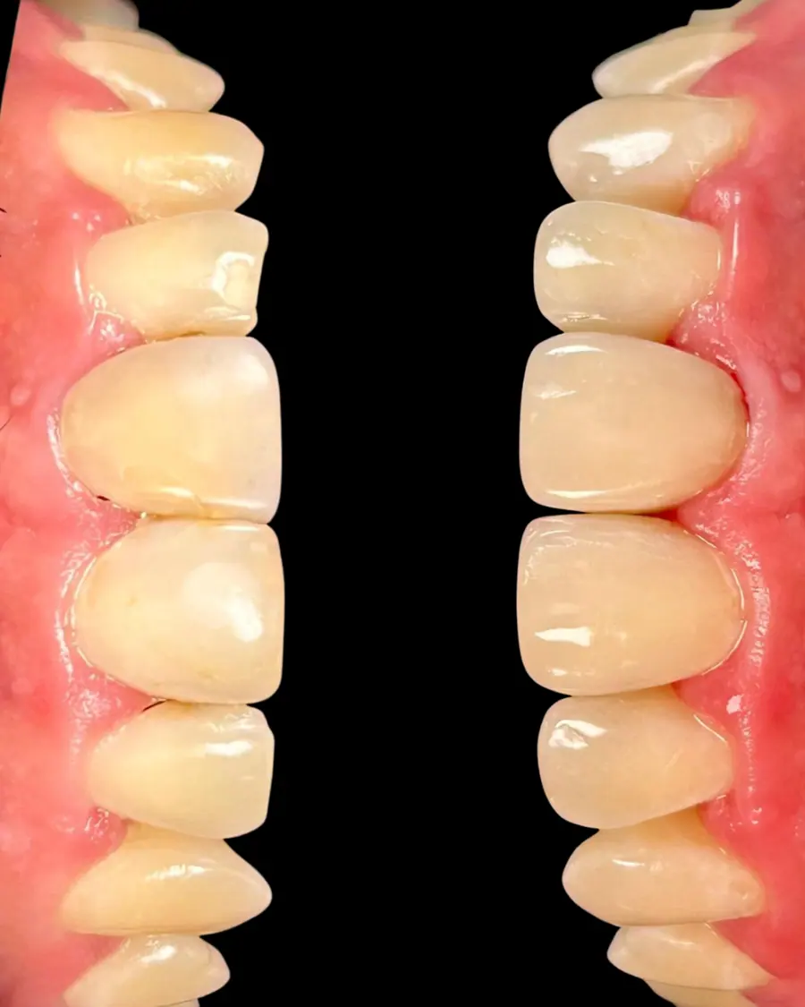 Facetas em resina - caso 42