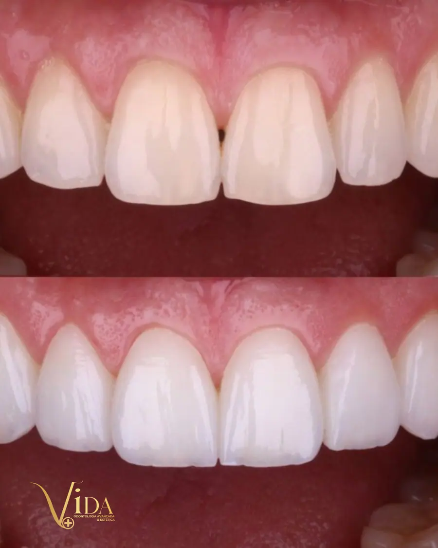 Facetas em resina - caso 43