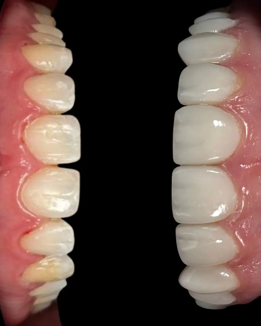Facetas em resina - caso 44