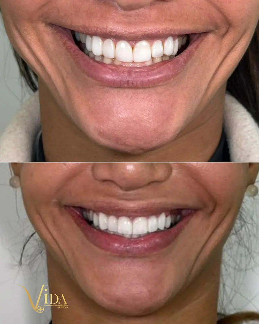 Facetas em resina - caso 45