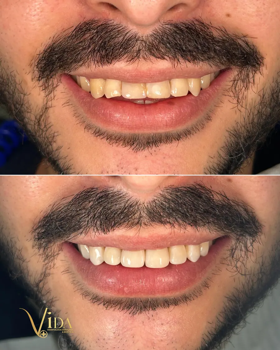 Facetas em resina - caso 46