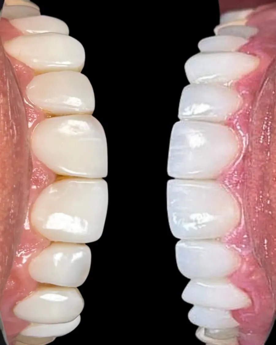 Facetas em resina - caso 47
