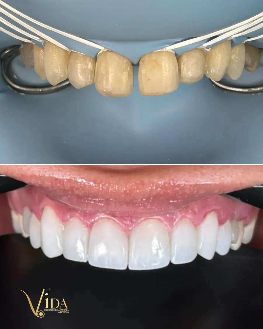 Facetas em resina - caso 48