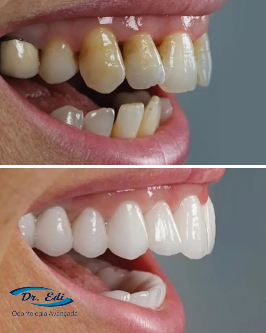 Facetas em resina - caso 53