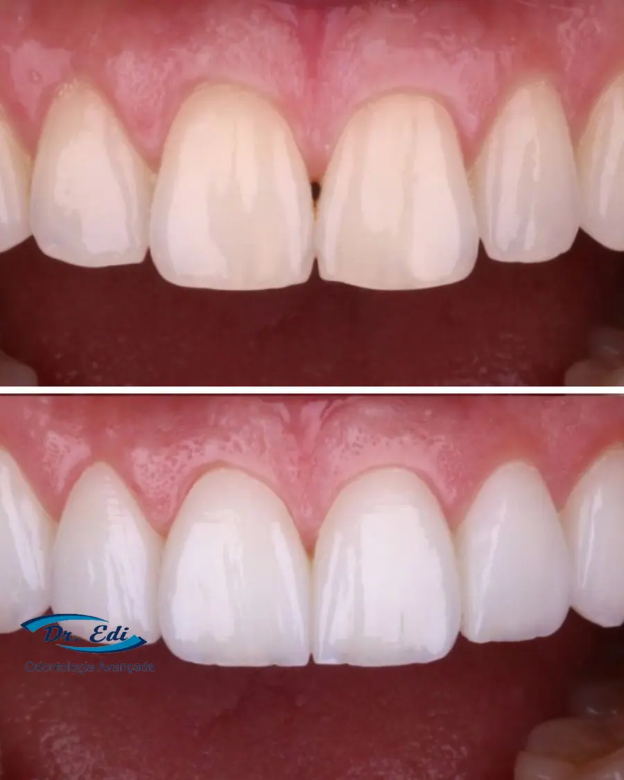 Facetas em resina - caso 55
