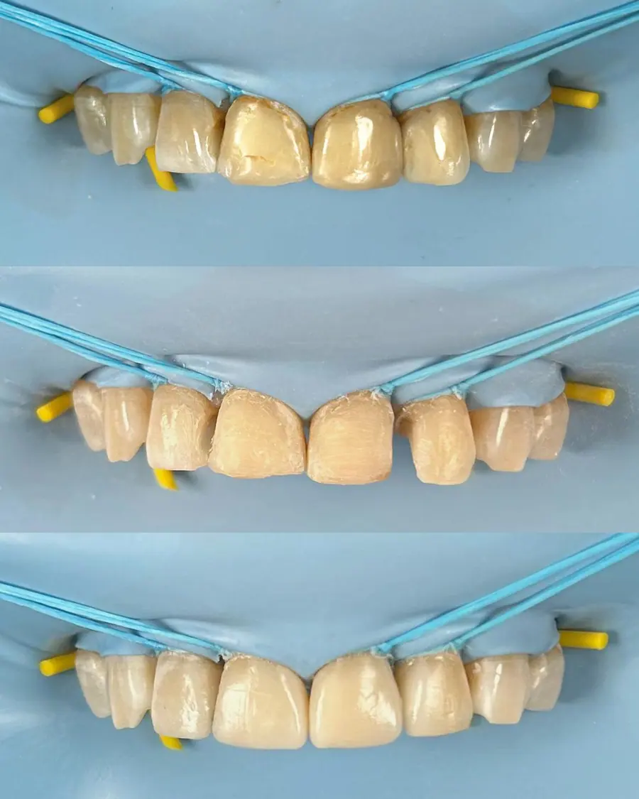Facetas em resina - caso 56