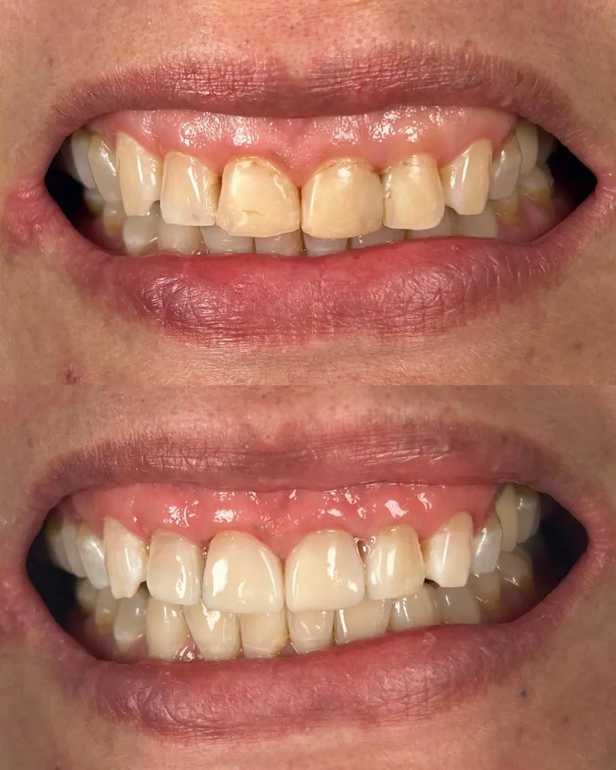 Facetas em resina - caso 58