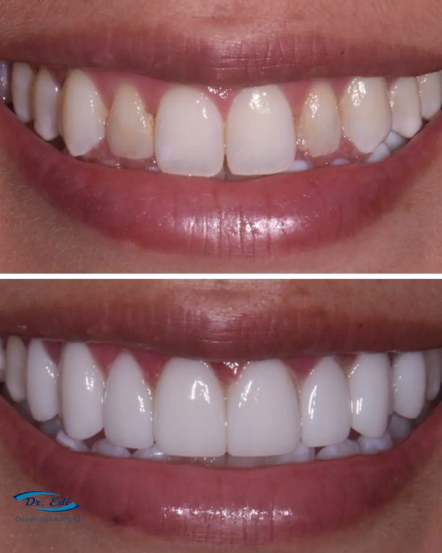 Facetas em resina - caso 60