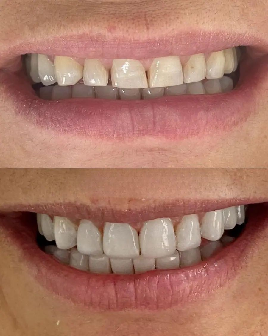 Facetas em resina - caso 62