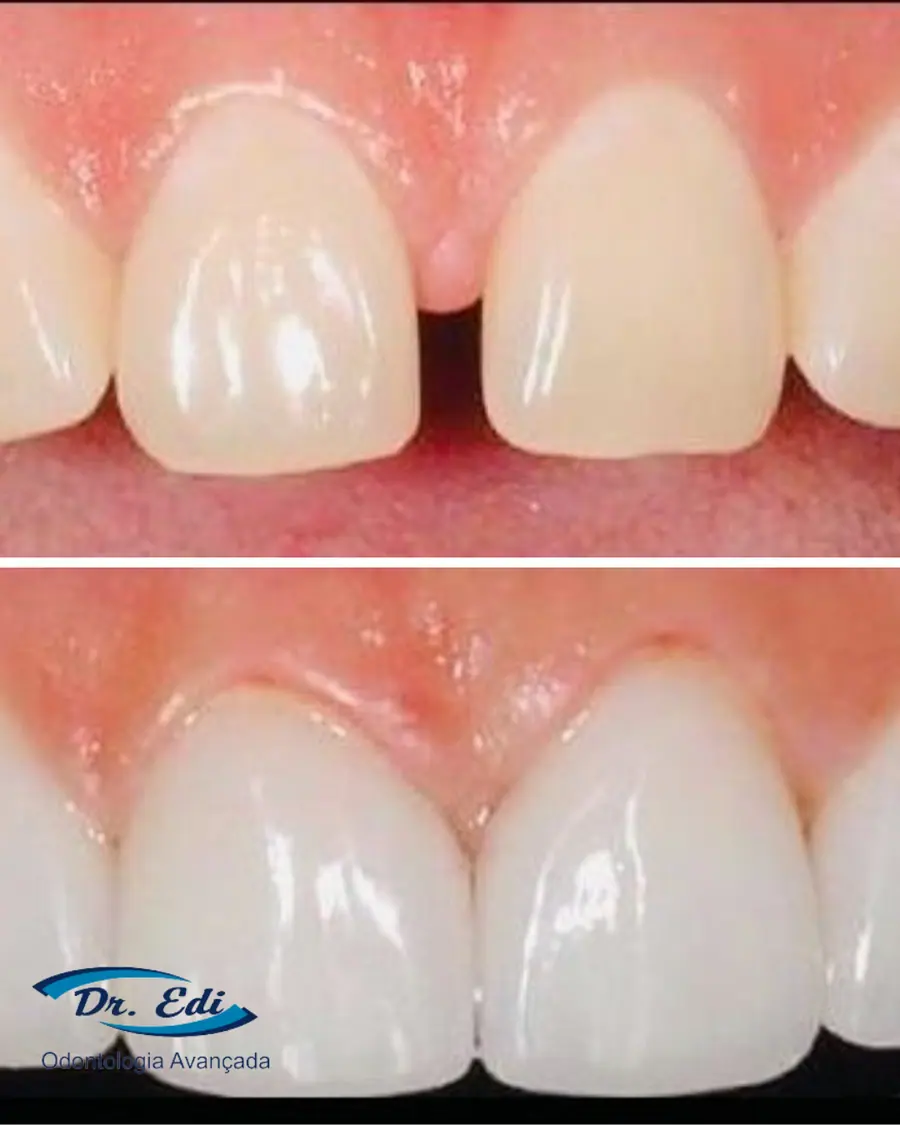 Facetas em resina - caso 63