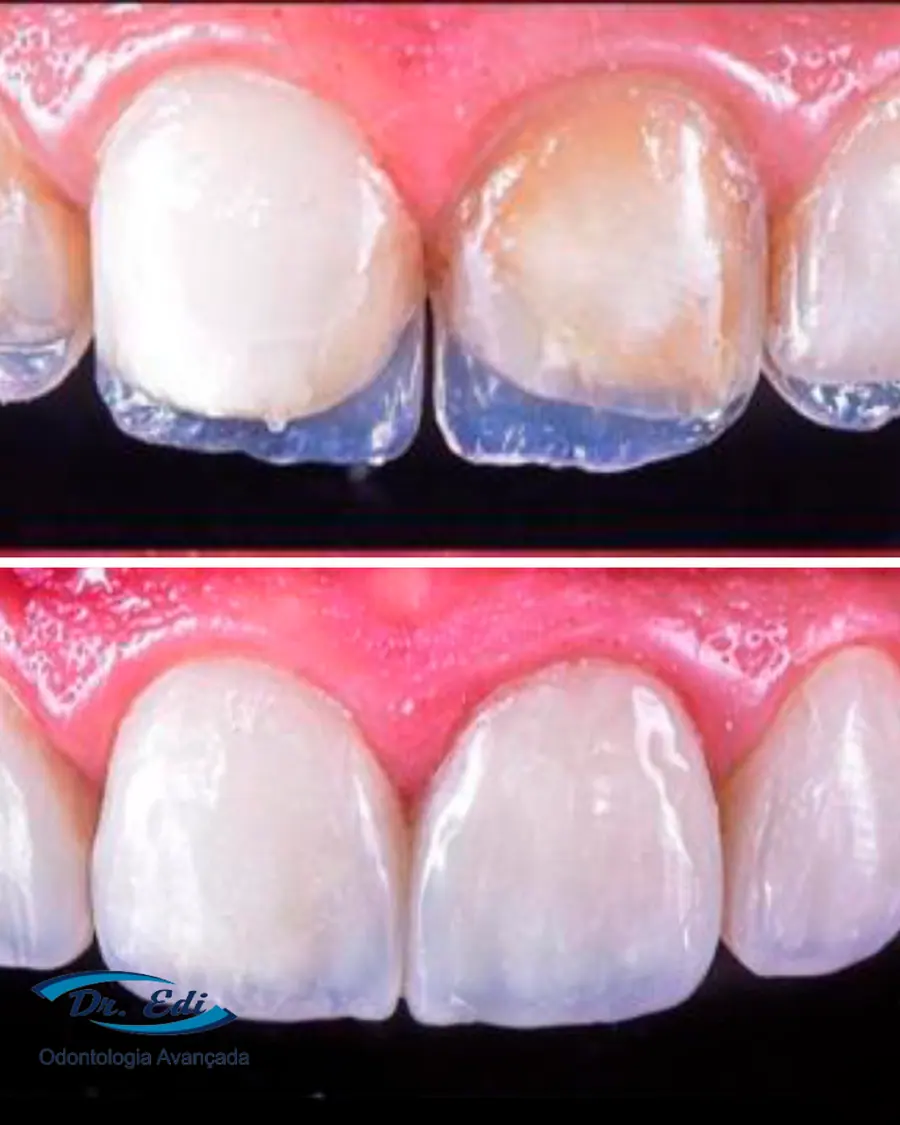 Facetas em resina - caso 64