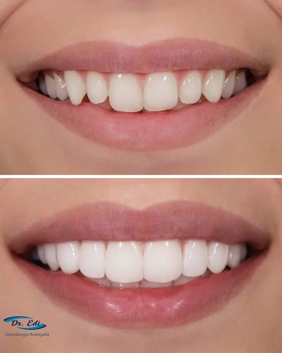 Facetas em resina - caso 65