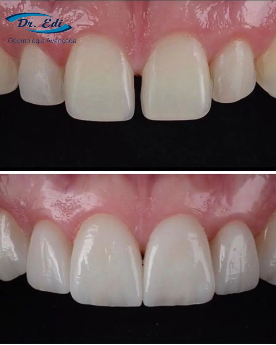 Facetas em resina - caso 67