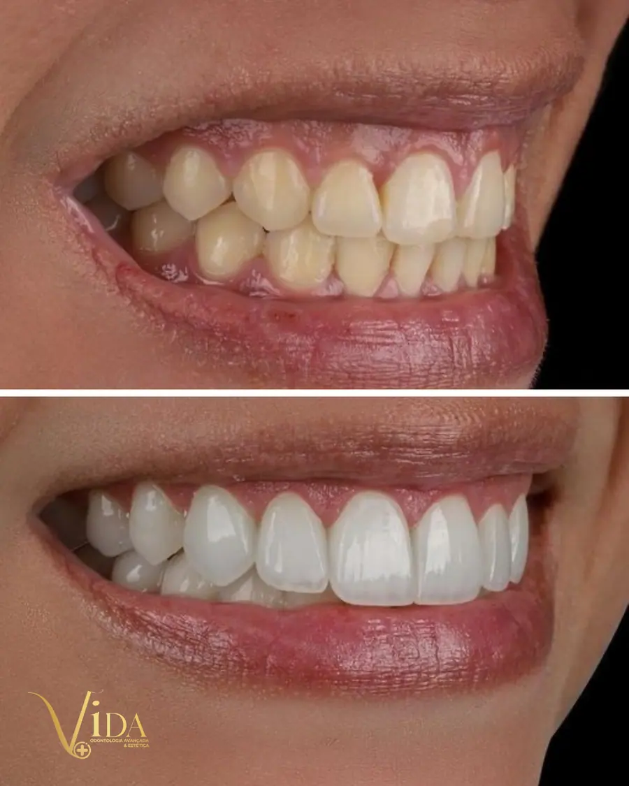 Facetas em resina - caso 69