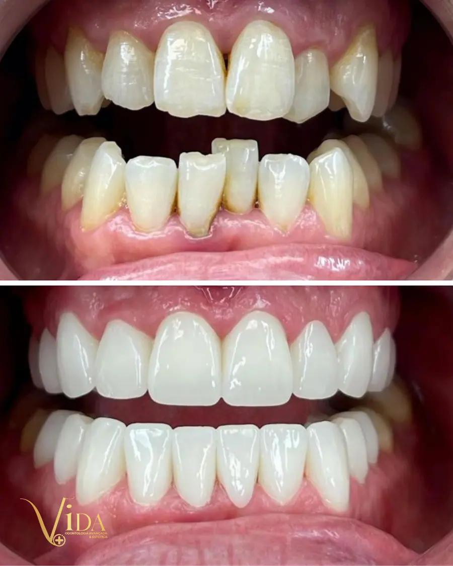 Facetas em resina - caso 70