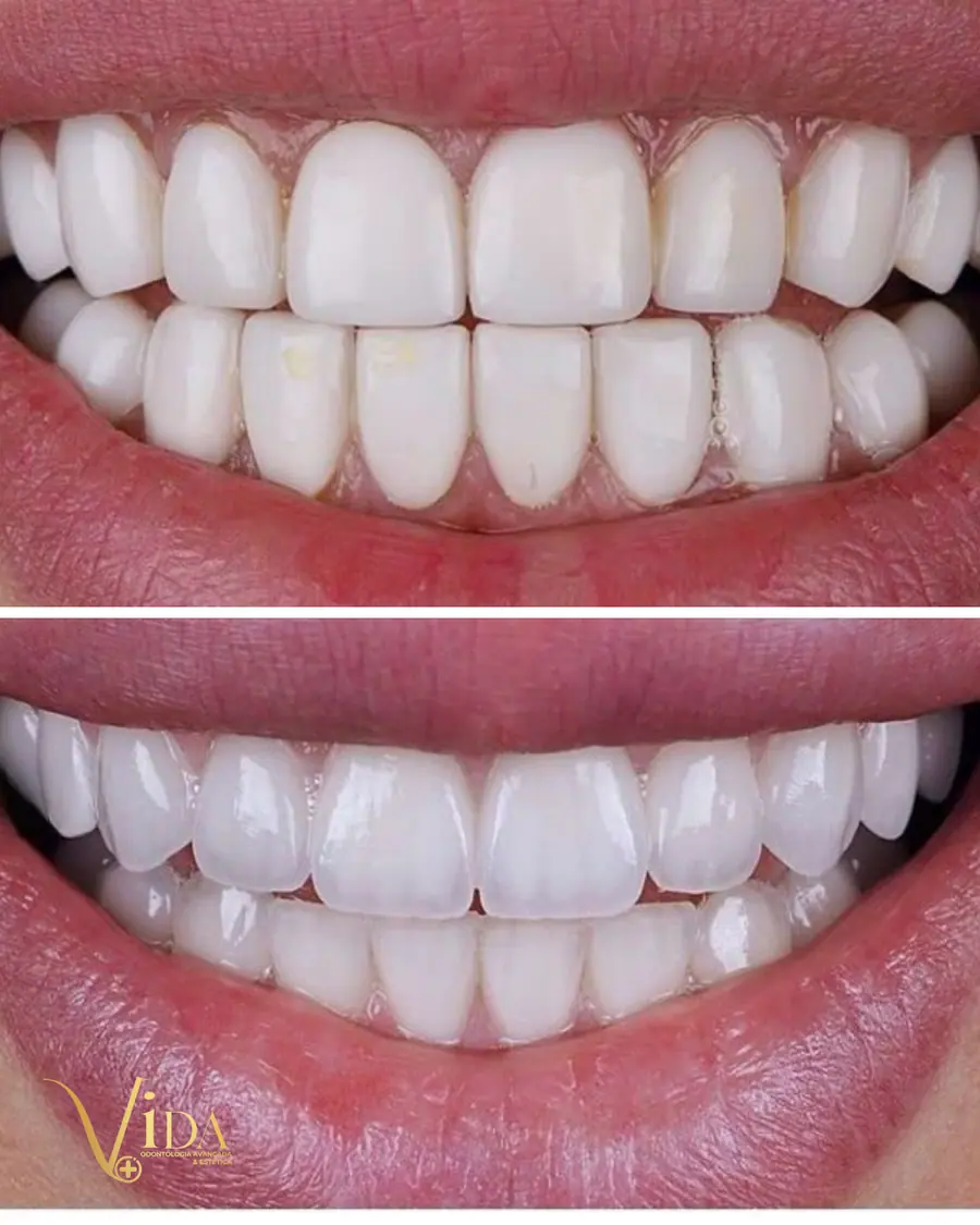 Facetas em resina - caso 71