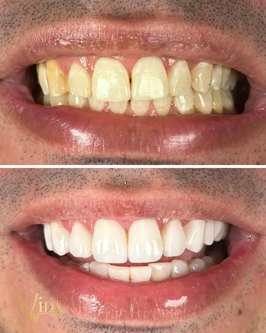 Facetas em resina - caso 73