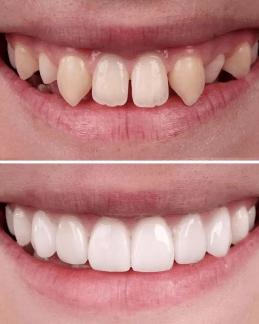Facetas em resina - caso 74