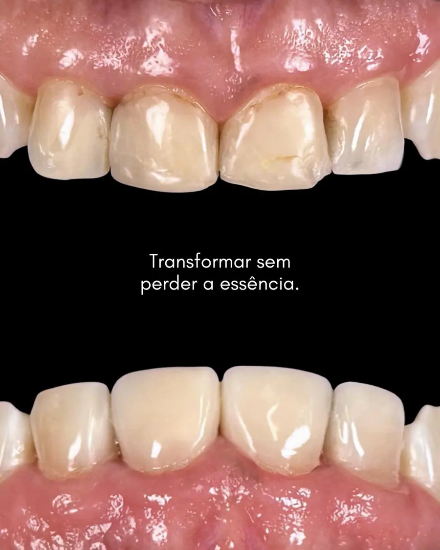 Facetas em resina - caso 75