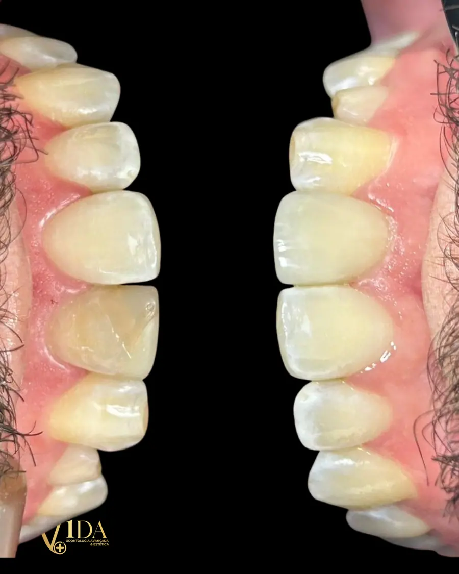 Facetas em resina - caso 77