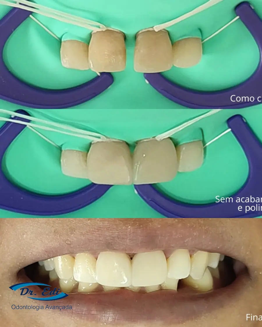 Fechamento de diastema - caso 1