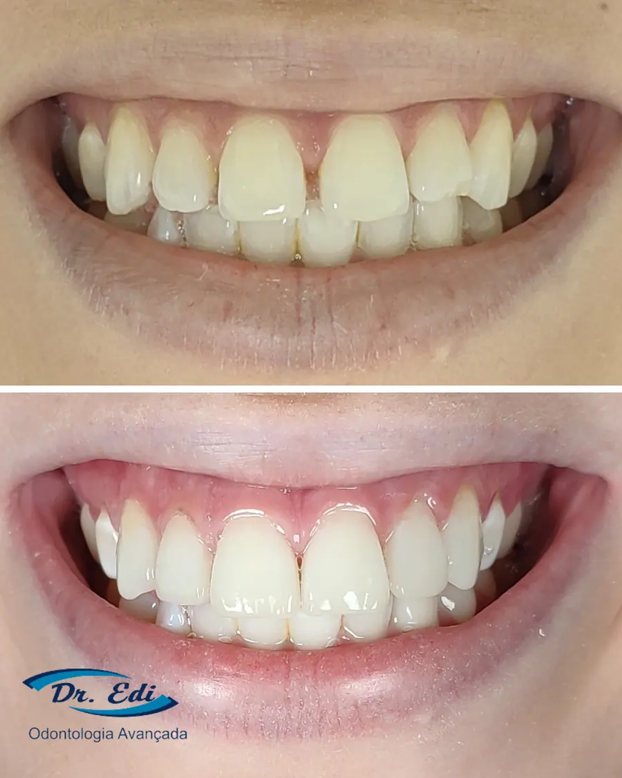 Fechamento de diastema - caso 2