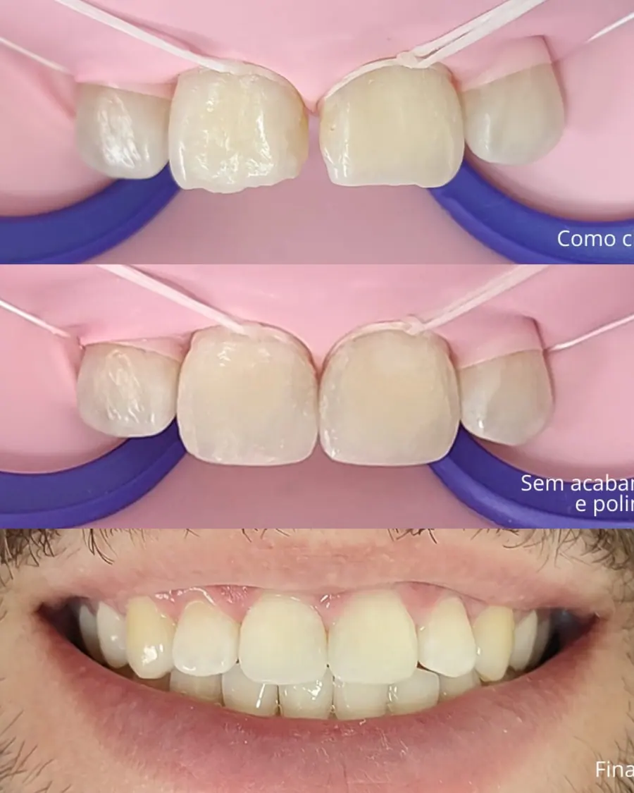 Fechamento de diastema - caso 3