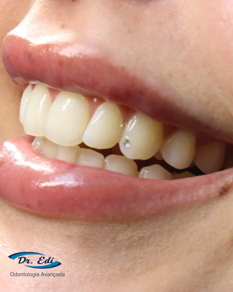 Piercing dental - caso 1