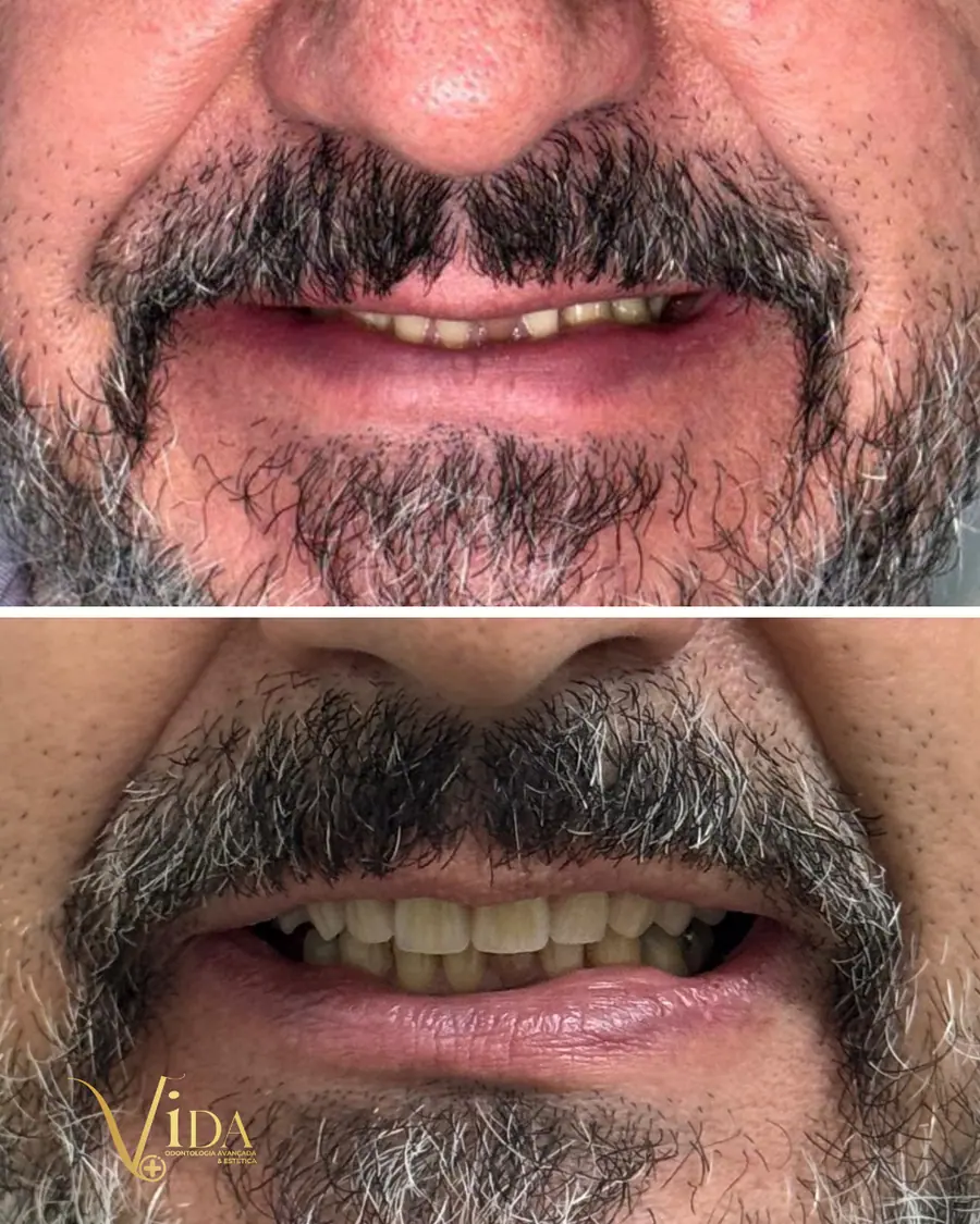 Resultados de reabilitação oral em campinas - imagem 9